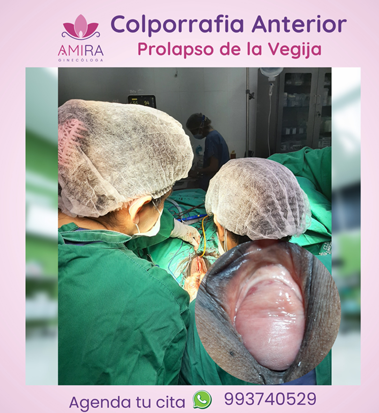 Amira Ginecologa Obstetra - COLPORRAFIA ANTERIOR