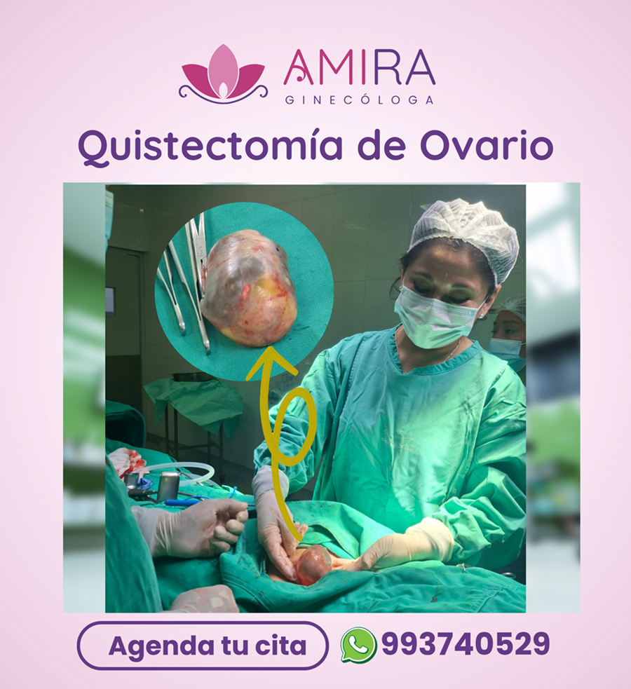 Amira Ginecologa Obstetra - Quistectomia de Ovario